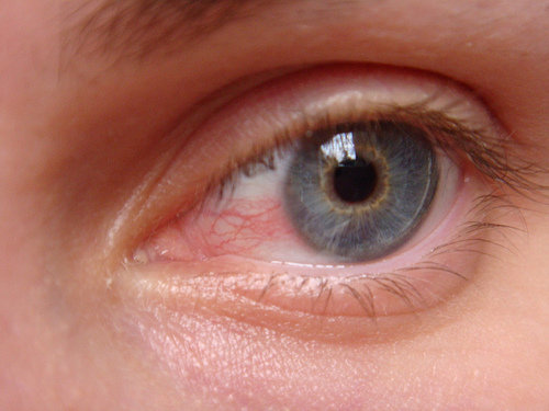 oeil-rouge-apres-la-baignade-en-piscine-chloree